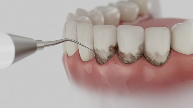 Trusted Invisalign Clear Aligners service in Mechanicsburg, OH - Dentist Open Now